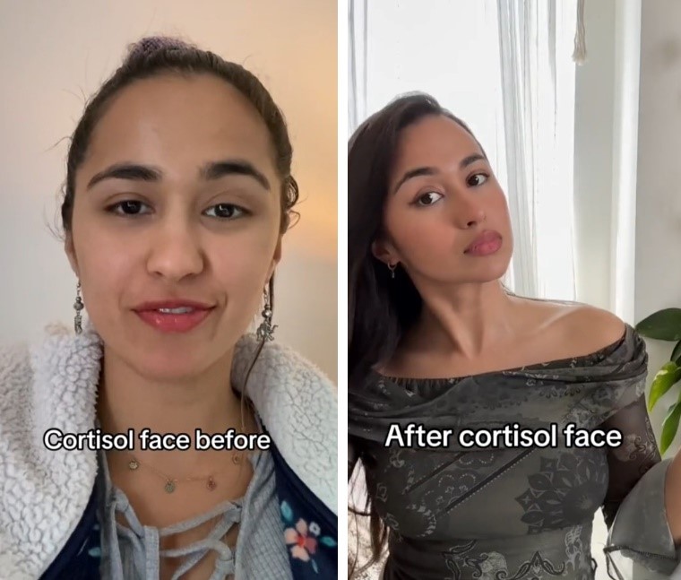 Steroids Moon Face Steroids Moon Face
