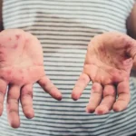 Since the start of the year, 733 measles cases have been confirmed in the United States.