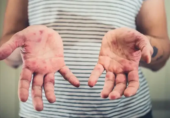 Since the start of the year, 733 measles cases have been confirmed in the United States.