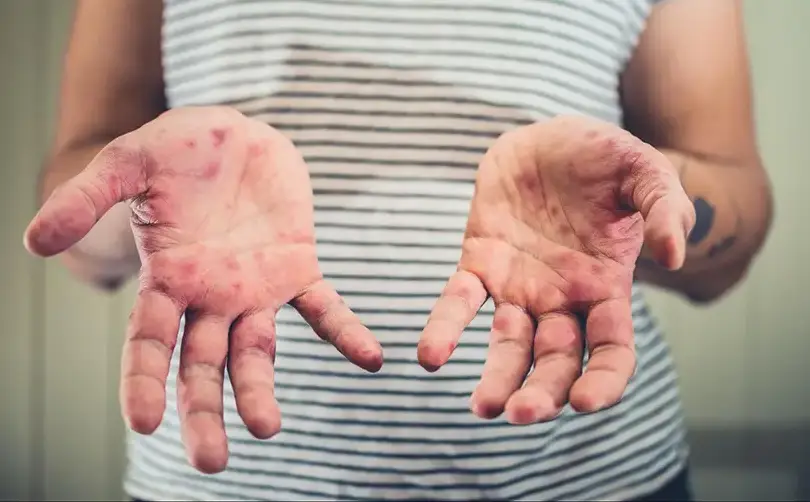 Since the start of the year, 733 measles cases have been confirmed in the United States.